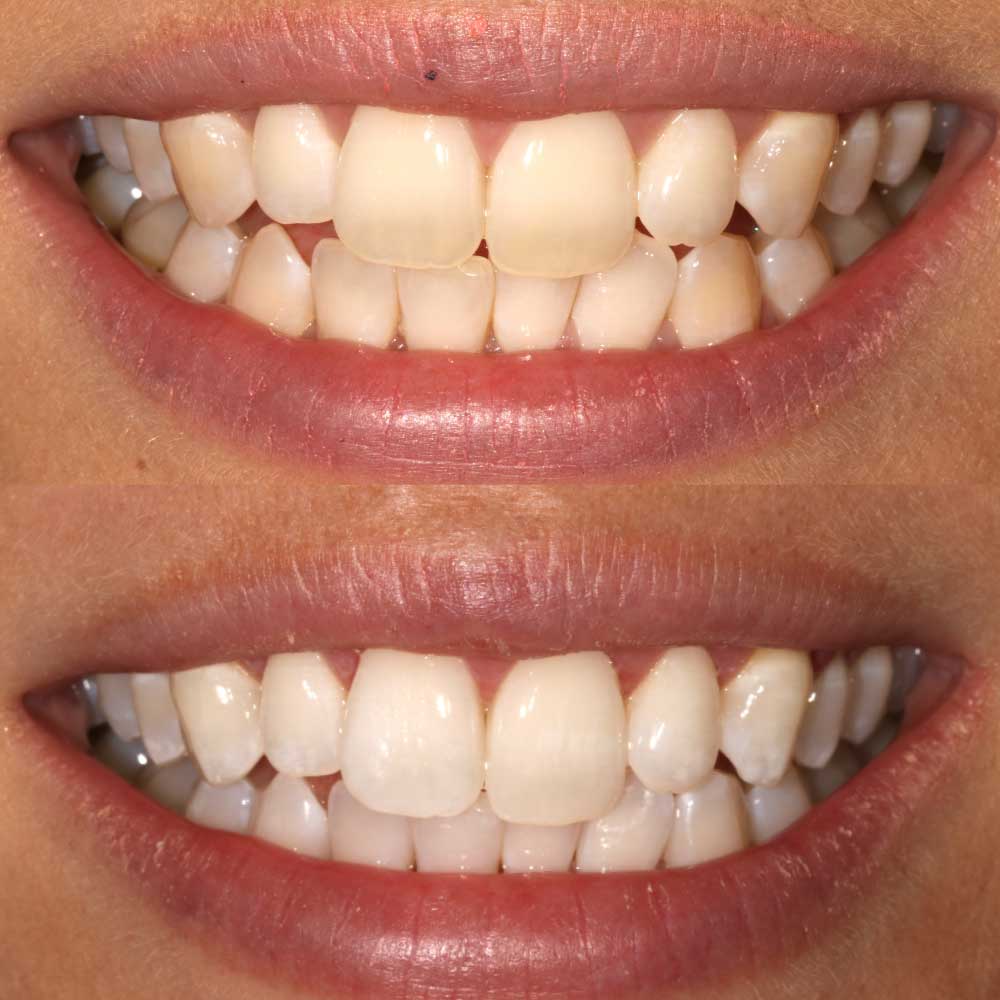 Khare Dental Clinic Teeth Whitening