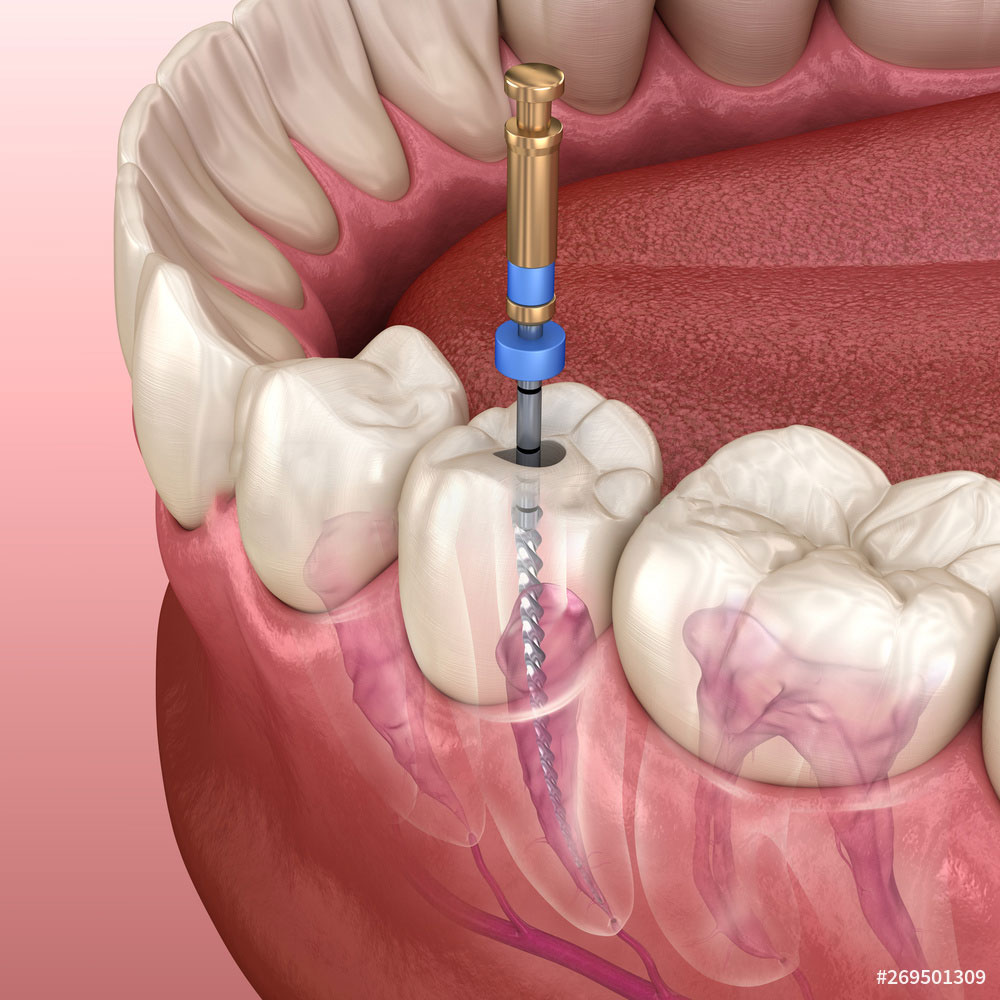 Khare Dental Clinic Root Canal Treatment